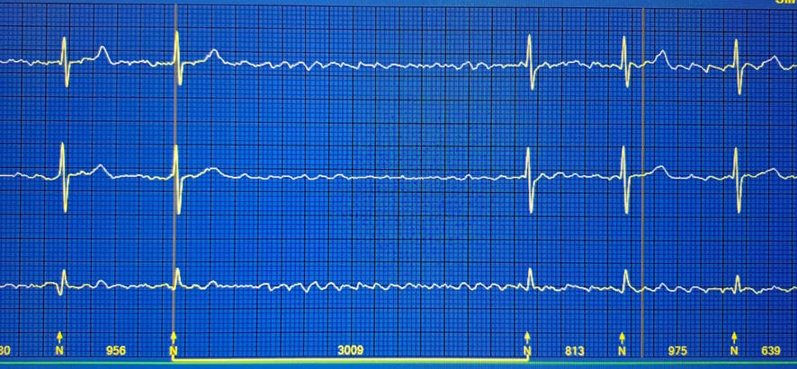Otra imagen del proceso de colocación de un holter